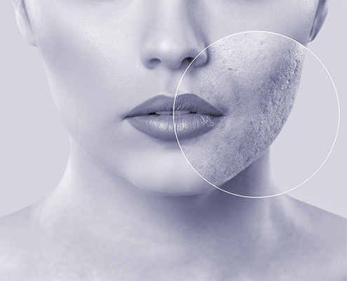 MK Huidspecialist - behandeling acné
